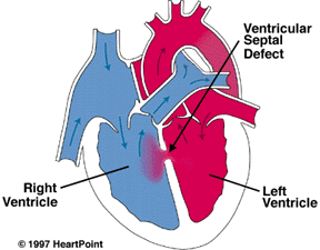 Cartoon showing VSD and how blood should flow in the heart
